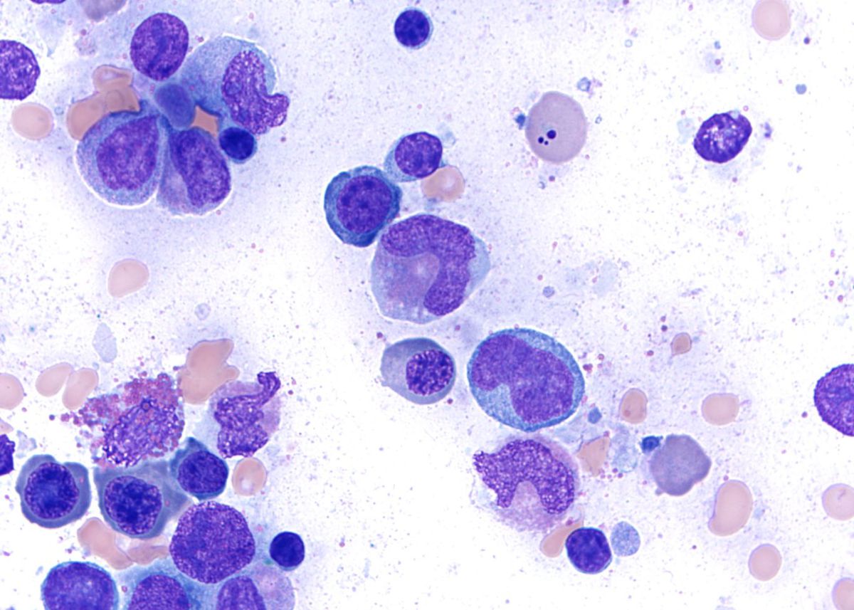Bone marrow - Dysgranulopoiesis, nucleus to cytoplasmic dyssynchrony, giant neutrophilic bands and metamyelocytes.